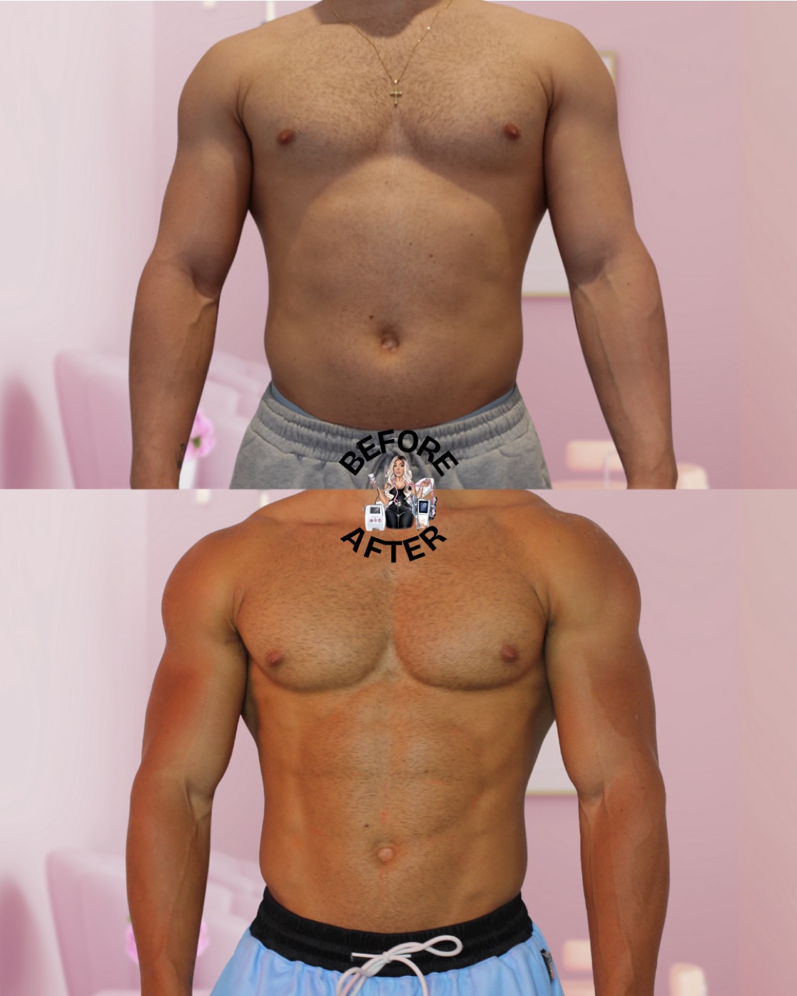 Before and after comparison of a client's midsection after a course of body contouring treatments