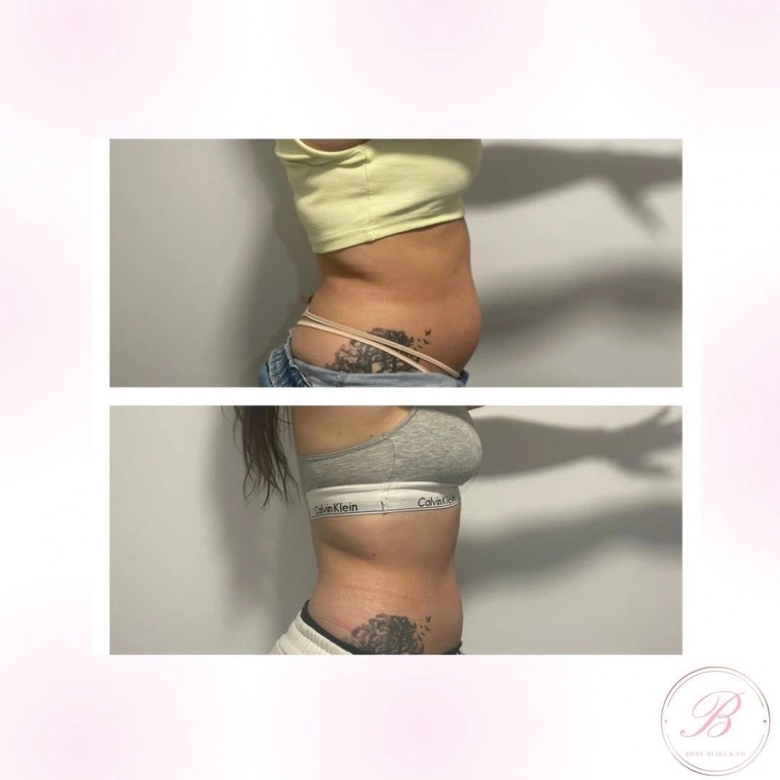 Before and after body contouring result