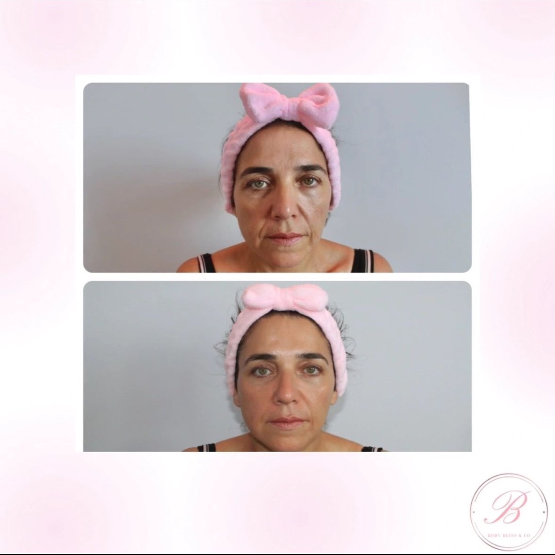 Before and after body contouring result