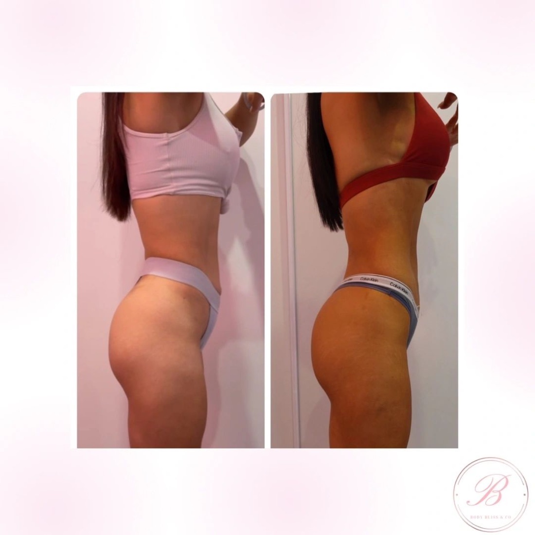 Before and after body contouring result