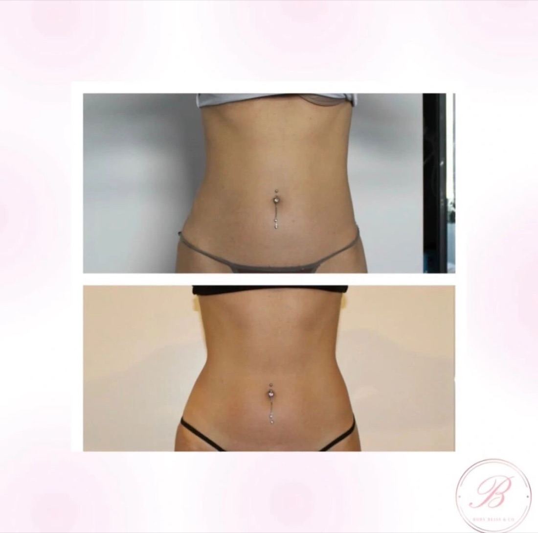 Before and after body contouring result
