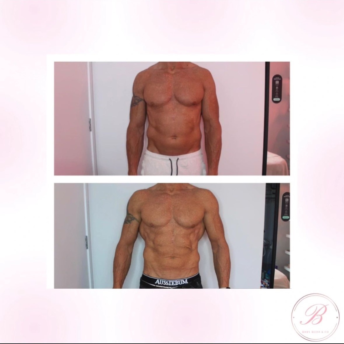 Before and after body contouring result