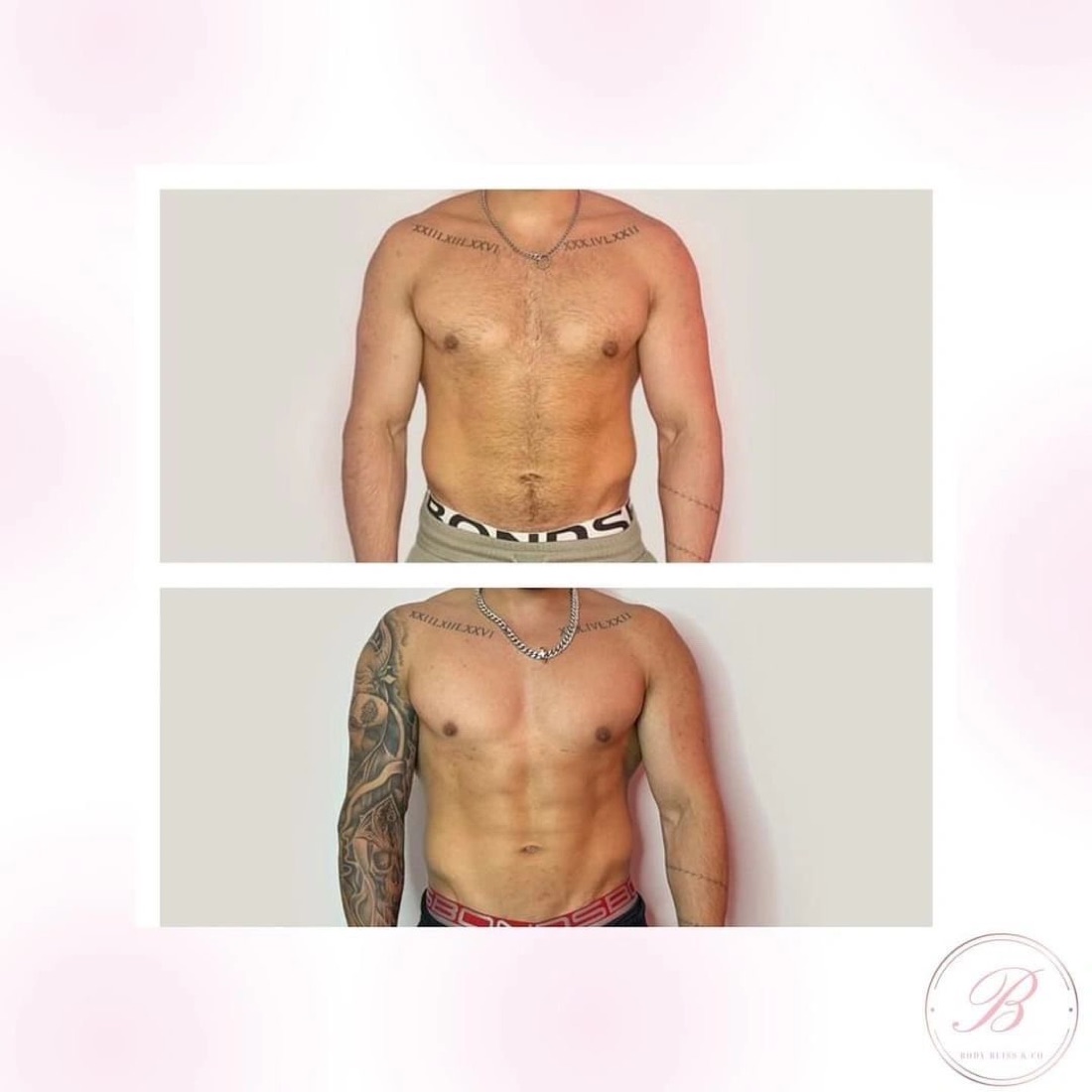 Before and after body contouring result