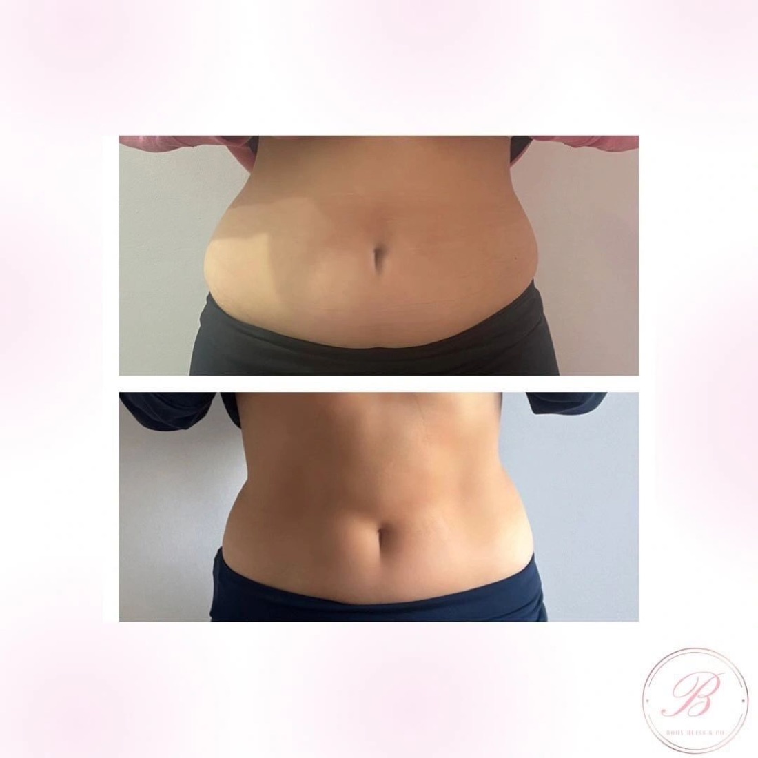 Before and after body contouring result