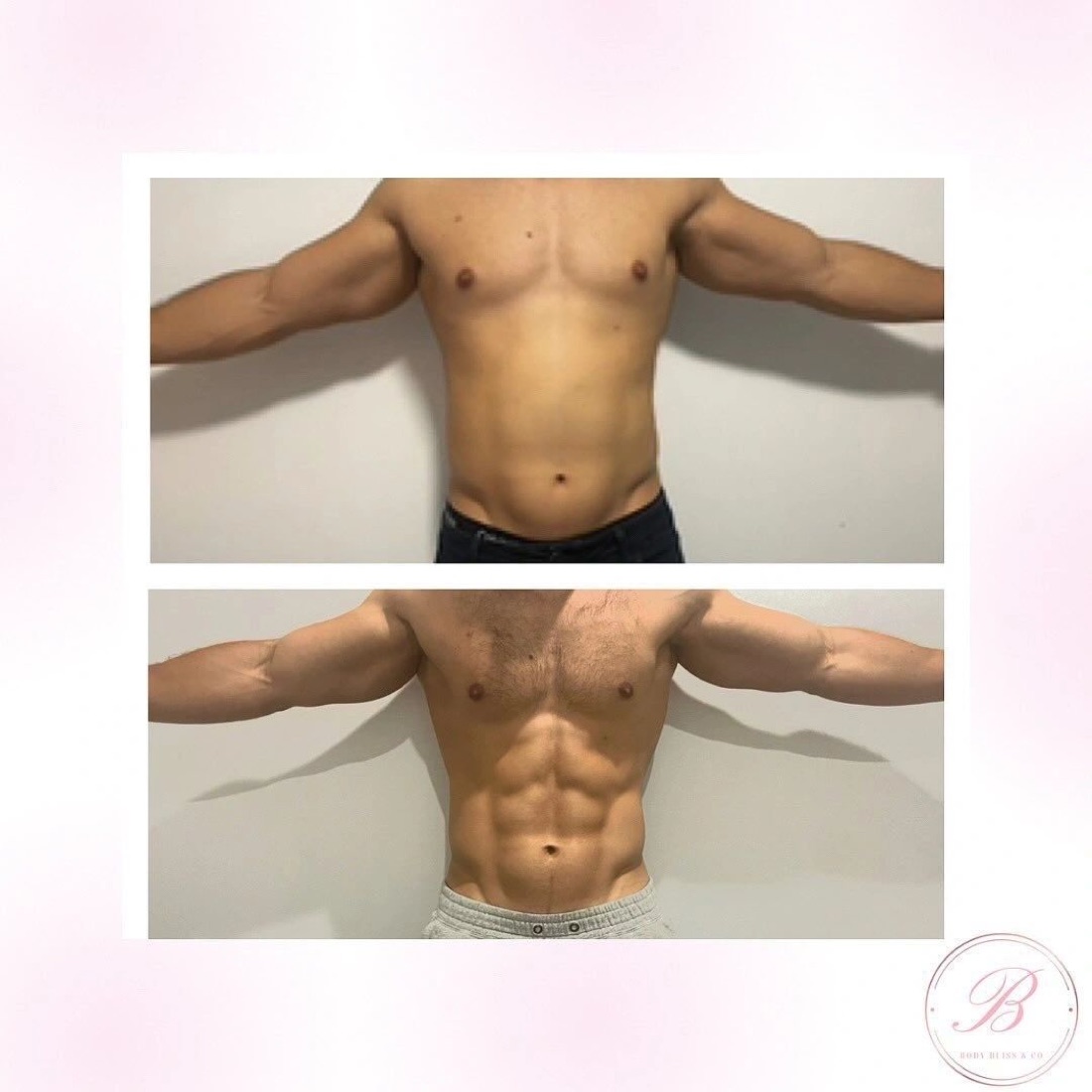 Before and after body contouring result