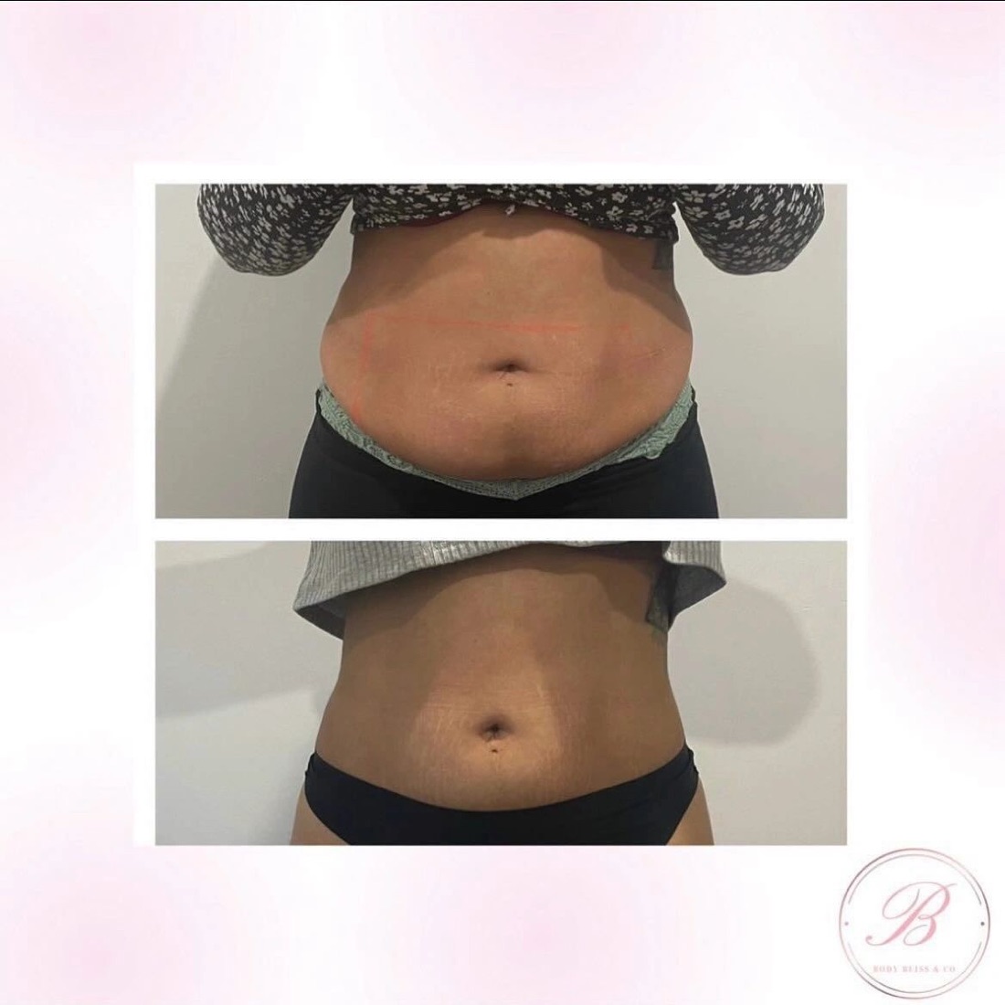 Before and after body contouring result