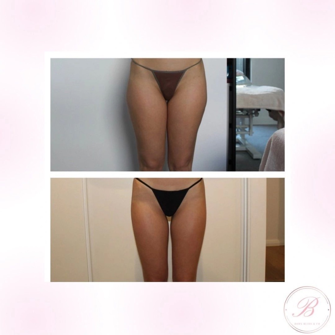 Before and after body contouring result