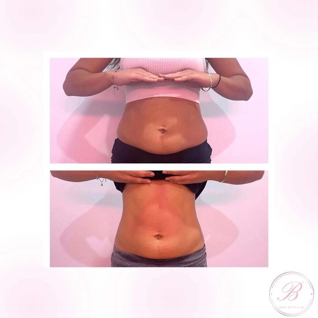Before and after body contouring result