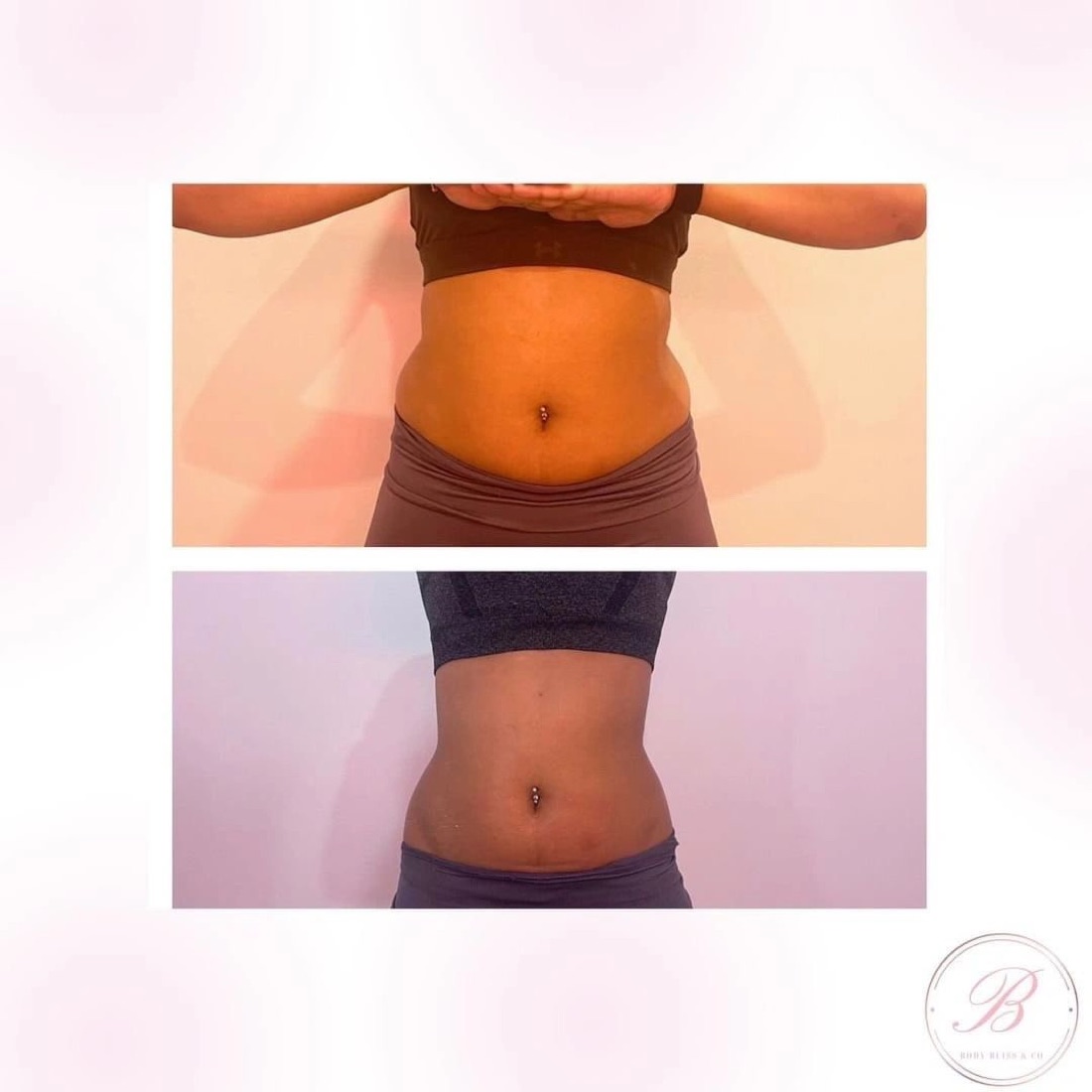 Before and after body contouring result