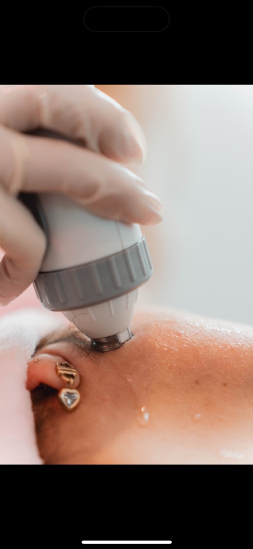 Radiofrequency face and jaw contouring treatment on a client